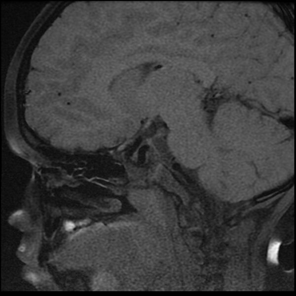 File:Adamantinomatous craniopharyngioma (Radiopaedia 77407-89529 Sagittal T1 fat sat 10).jpg