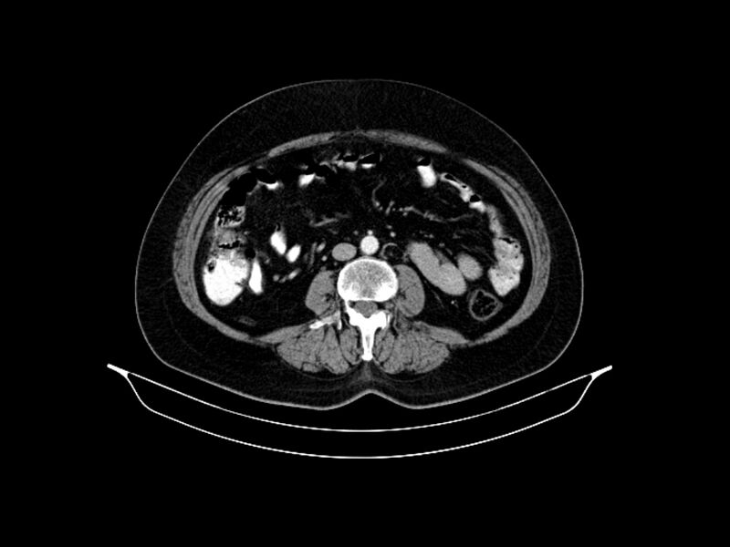 File:Adenocarcinoma of pancreas with hepatic metastasis (Radiopaedia 64332-73122 Axial C+ portal venous phase 58).jpg