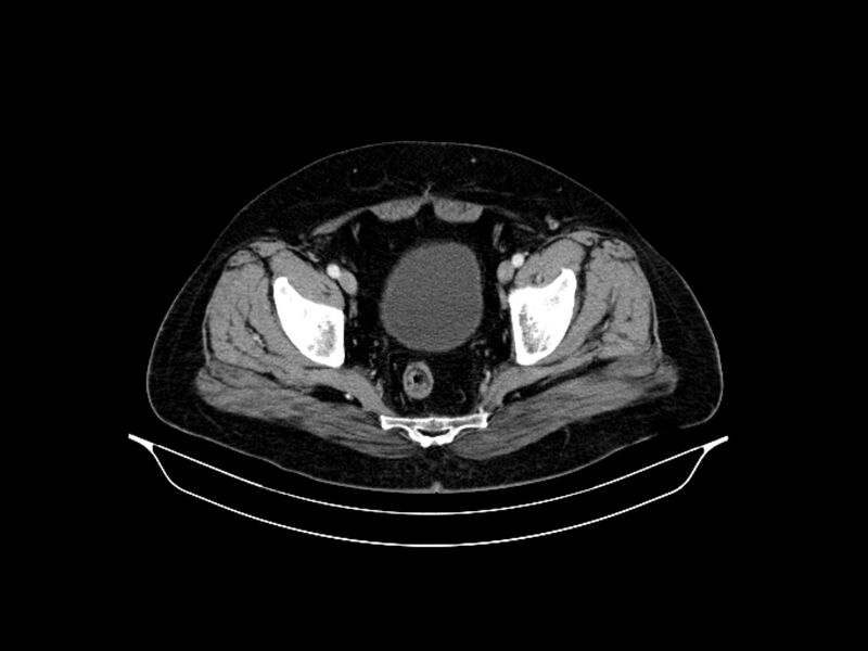 File:Adenocarcinoma of pancreas with hepatic metastasis (Radiopaedia 64332-73122 Axial C+ portal venous phase 90).jpg