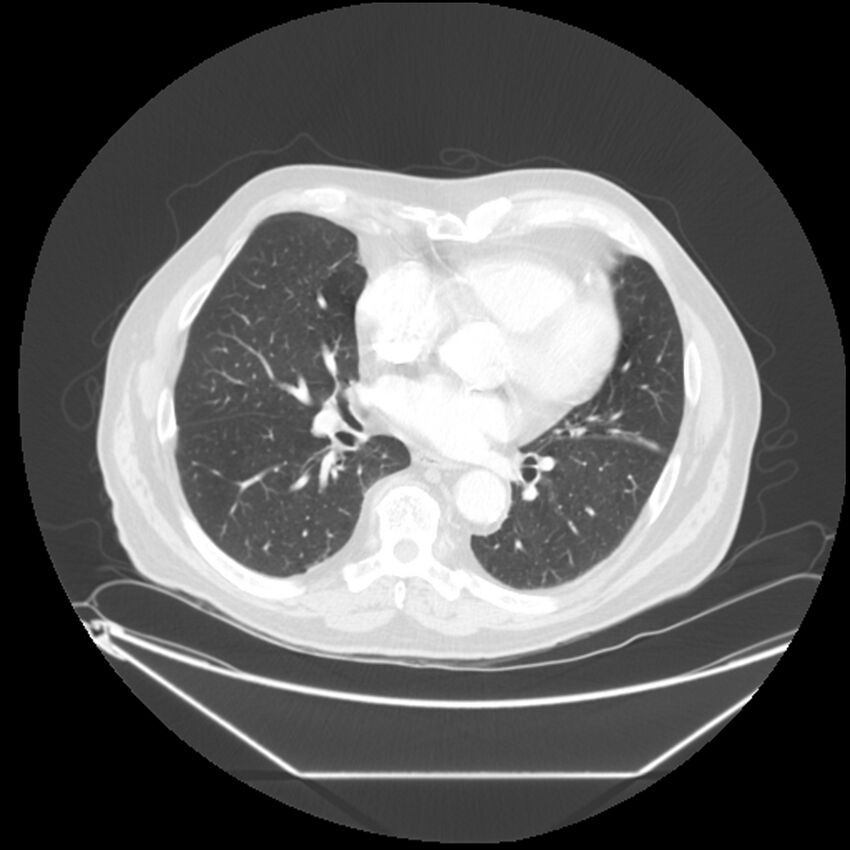 Adenocarcinoma of the lung (Radiopaedia 44876-48759 Axial lung window 46).jpg