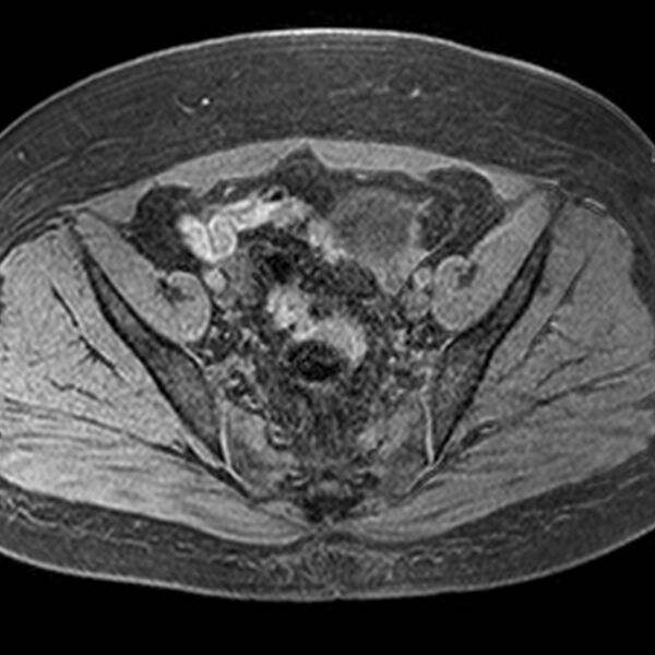 File:Adenomyoma of the uterus (Radiopaedia 9871-10439 Axial T1 fat sat 14).jpg