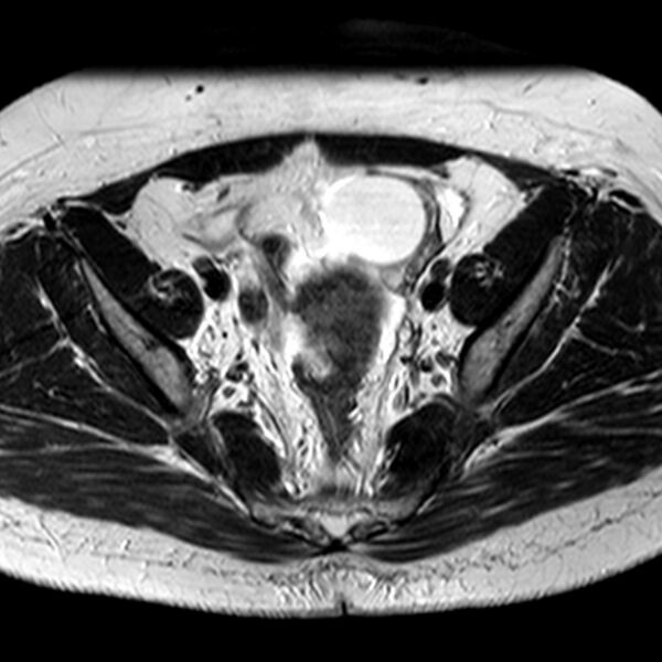 File:Adenomyoma of the uterus (Radiopaedia 9871-10439 Axial T2 20).jpg