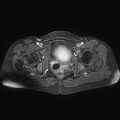 Adenomyoma of the uterus (huge) (Radiopaedia 9870-10438 Axial T1 C+ fat sat 9).jpg