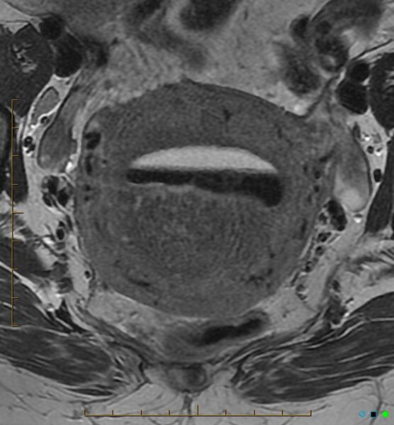 File:Adenomyosis uterus with hematometra (Radiopaedia 45779-50011 Axial T2 15).jpg