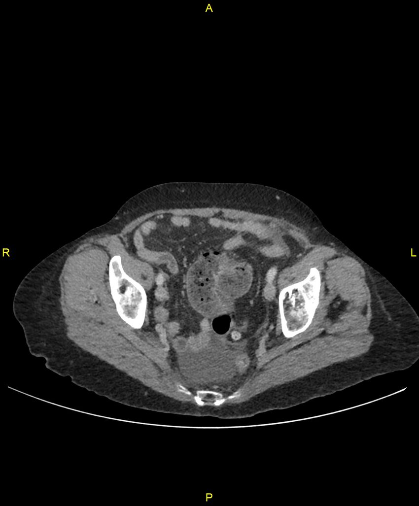 Adhesional small bowel obstruction (Radiopaedia 85402-101024 Axial C+ portal venous phase 245).jpg