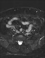 Adnexal multilocular cyst (O-RADS US 3- O-RADS MRI 3) (Radiopaedia 87426-103754 Axial T2 fat sat 2).jpg