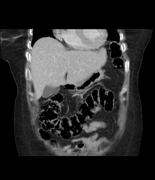 File:Adrenal cortical carcinoma with IVC invasion and thrombosis (Radiopaedia 34307-35597 Coronal C+ portal venous phase 16).jpg