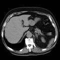 Adrenal hemangioma (Radiopaedia 11039-11445 Axial non-contrast 2).jpg