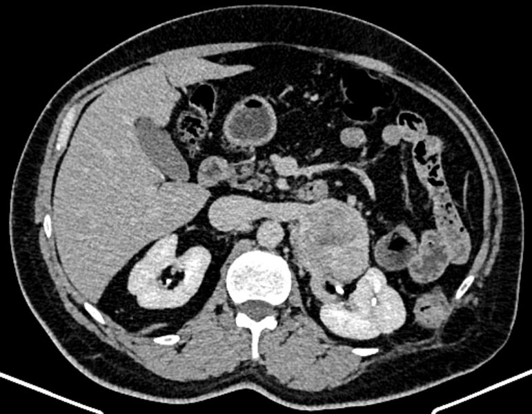 File:Adrenal metastases (Radiopaedia 73082-83791 Axial C+ delayed 121).jpg