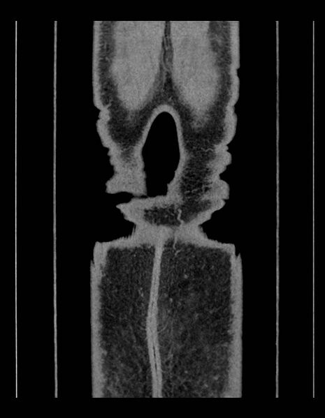 File:Adrenal myelolipoma - bilateral (Radiopaedia 74805-85810 Coronal C+ portal venous phase 31).jpg