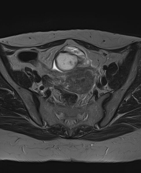 File:Adult granulosa cell tumor of the ovary (Radiopaedia 71581-81950 Axial T2 11).jpg
