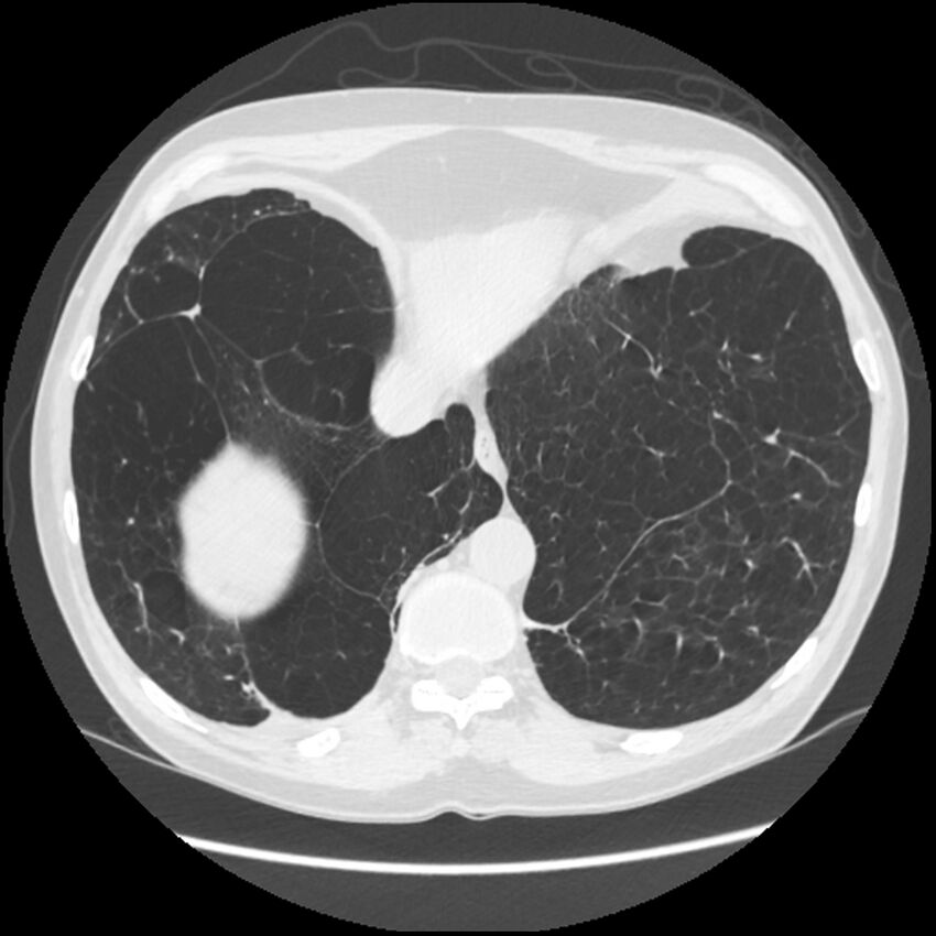 Alpha-1-antitrypsin deficiency (Radiopaedia 40993-43722 Axial lung window 205).jpg