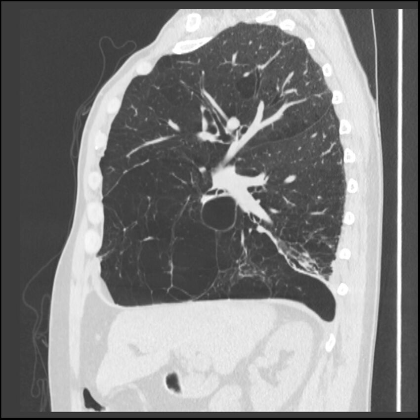 Alpha-1-antitrypsin deficiency (Radiopaedia 40993-43722 Sagittal lung window 175).jpg