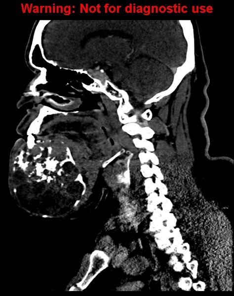 File:Ameloblastoma (Radiopaedia 33126-34164 F 33).jpg