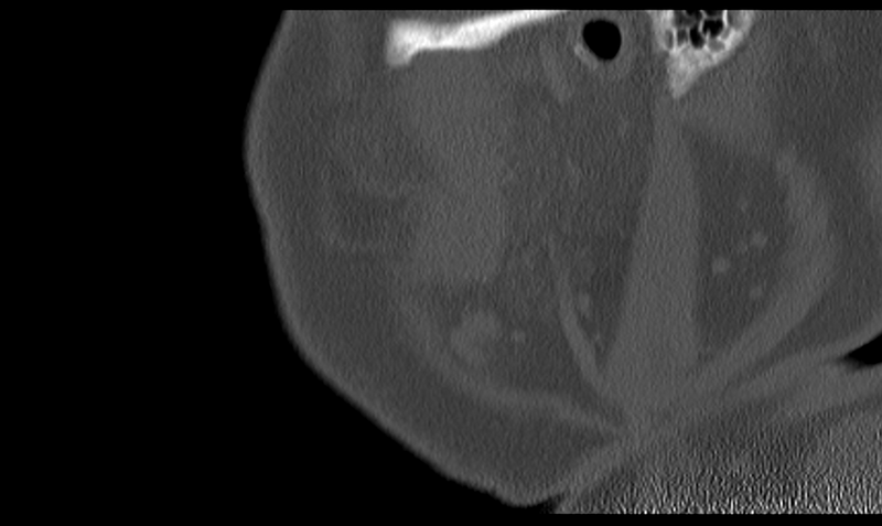 File:Ameloblastoma (Radiopaedia 33677-34806 Sagittal bone window 11).png