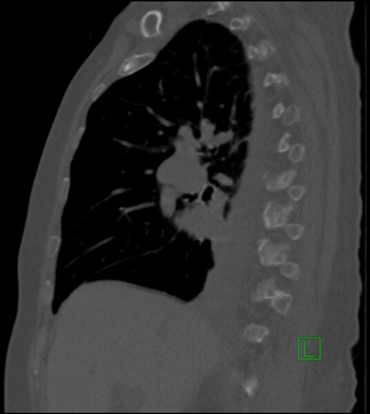 File:Amiodarone deposition in the liver (Radiopaedia 77587-89780 Sagittal bone window 62).jpg