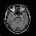 Amnestic syndrome secondary to hypoxic brain injury (Radiopaedia 24743-25004 FLAIR 7).jpg