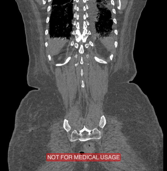 File:Amoebic enterocolitis with liver abscess (Radiopaedia 35100-36609 B 183).jpg