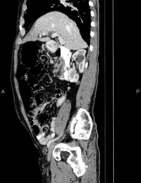 File:Ampullary adenocarcinoma (Radiopaedia 86093-102032 D 31).jpg