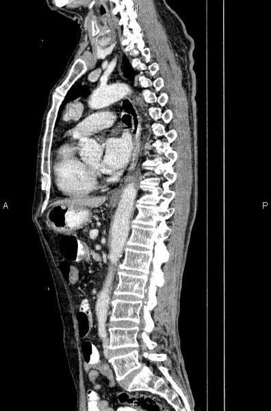 File:Ampullary adenocarcinoma (Radiopaedia 86093-102033 E 51).jpg