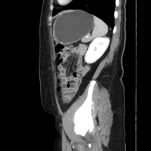 File:Ampullary tumor (Radiopaedia 22787-22816 D 43).jpg