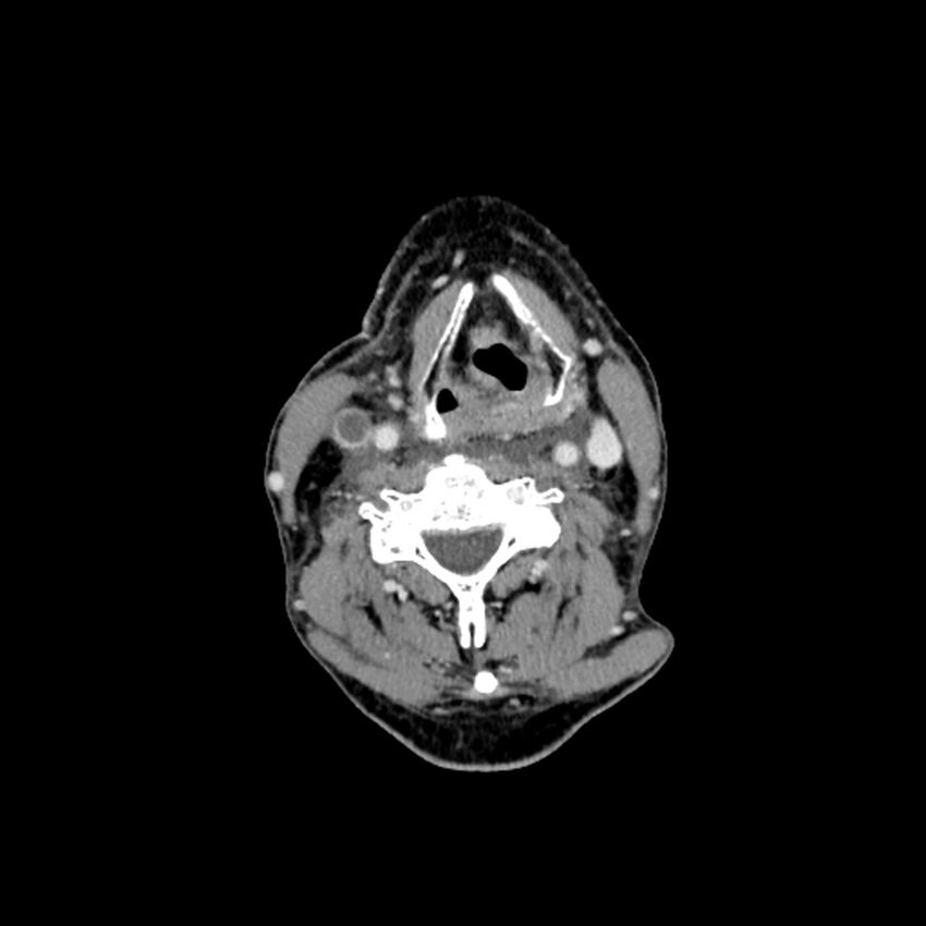 Anaplastic thyroid carcinoma (Radiopaedia 79087-92034 B 64).jpg