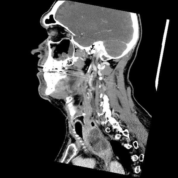 File:Anaplastic thyroid carcinoma (Radiopaedia 79087-92034 C 60).jpg