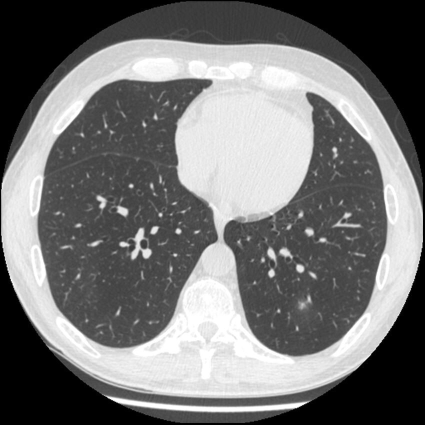 Angioinvasive aspergillosis (Radiopaedia 43957-47466 Axial lung window 47).jpg