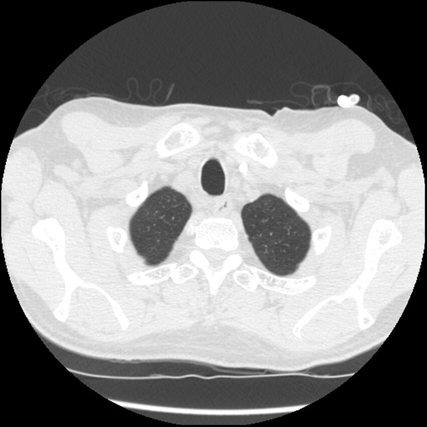 Angioinvasive aspergillosis (Radiopaedia 43957-47466 Axial lung window 8).jpg