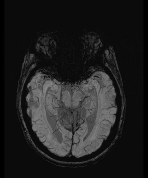 File:Angiomatous meningioma (Radiopaedia 79459-92579 E 25).jpg