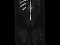 Ankylosing spondylitis (Radiopaedia 44609-48357 Coronal bone window 103).jpg