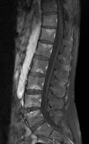 File:Ankylosing spondylitis - Andersson lesion (Radiopaedia 81878-95838 F 7).jpg