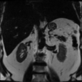 Annular pancreas (Radiopaedia 38292-40320 Coronal T2 8).png