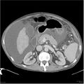 Annular pancreas and cirrhosis (Radiopaedia 24561-24843 A 6).jpg