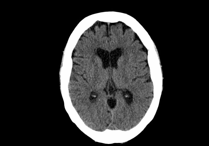File:Anomalous intracranial venous drainage (Radiopaedia 28161-28418 Axial non-contrast 23).jpg
