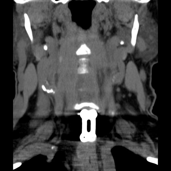 File:Anterior cervical postdiscectomy arthrodesis (Radiopaedia 32678-33646 Coronal non-contrast 6).jpg