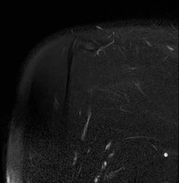 File:Anterior labral tear- extensive (Radiopaedia 73682-84476 Coronal T2 fat sat 25).jpg