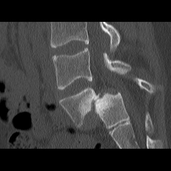 File:Anterolisthesis (Radiopaedia 22226-22263 Sagittal bone window 12).jpg
