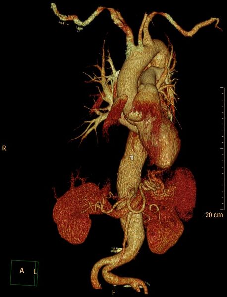 File:Aortic aneurysm and penetrating ulcer (Radiopaedia 23590-23704 3D reconstruction 1).jpg