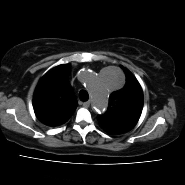 File:Aortic arch pseudoaneurysm (Radiopaedia 8534-9368 Axial non-contrast 18).jpg