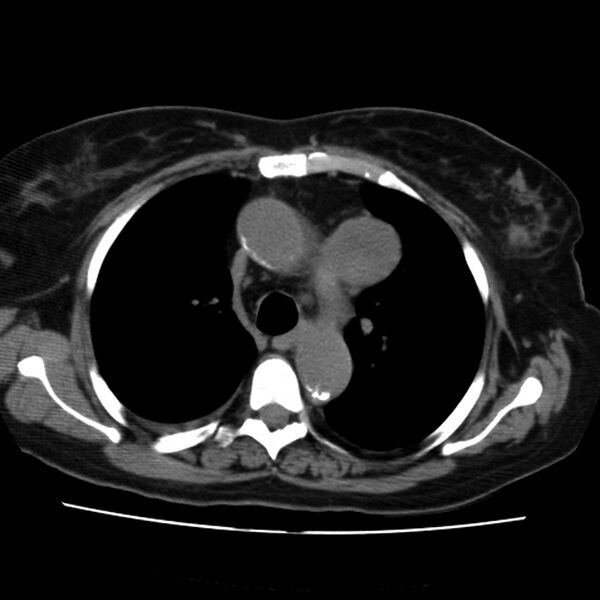 File:Aortic arch pseudoaneurysm (Radiopaedia 8534-9368 Axial non-contrast 25).jpg
