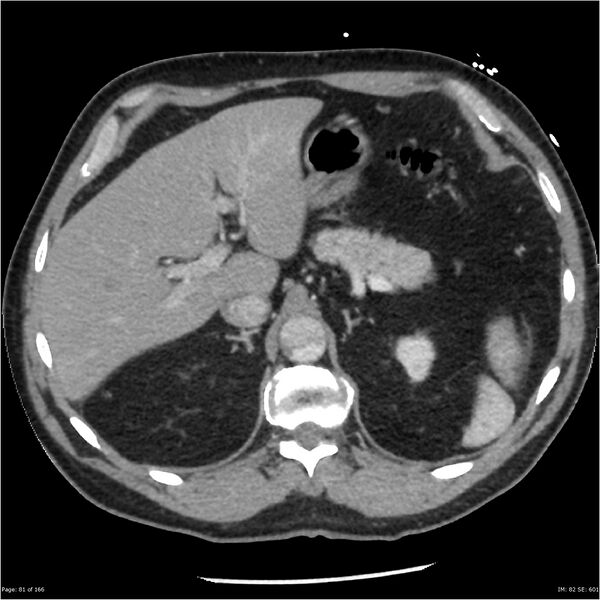 File:Aortic dissection- Stanford A (Radiopaedia 37759-39664 A 72).jpg