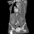 Aortic dissection (Radiopaedia 68763-78691 B 18).jpeg