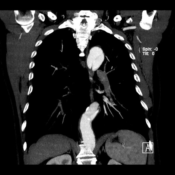 File:Aortic dissection - De Bakey type III - Stanford B (Radiopaedia 21903-21882 C 16).jpg