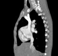 Aortopulmonary window, interrupted aortic arch and large PDA giving the descending aorta (Radiopaedia 35573-37074 C 3).jpg