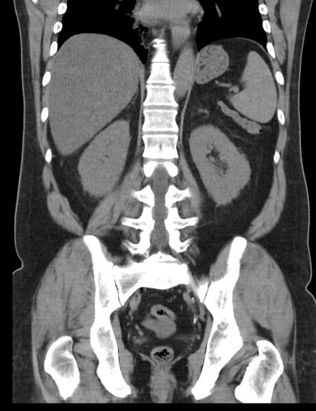File:Appendicitis and giant appendicolith (Radiopaedia 80251-93588 Coronal non-contrast 32).jpg