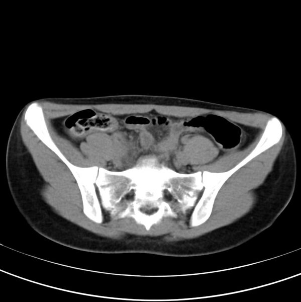 File:Appendicitis and incidental bicornuate uterus (Radiopaedia 22833-22853 Axial non-contrast 34).jpg