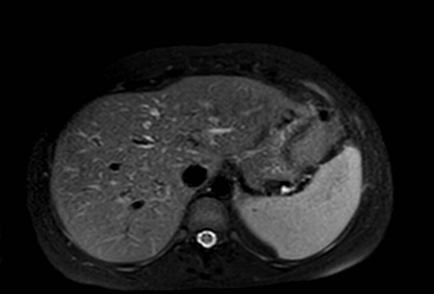 Appendicitis in gravida (MRI) (Radiopaedia 89433-106395 Axial T2 SPAIR 14).jpg