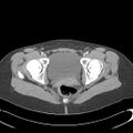 Appendicitis with minimal stranding but appendicolith (Radiopaedia 29035-29397 A 80).jpg