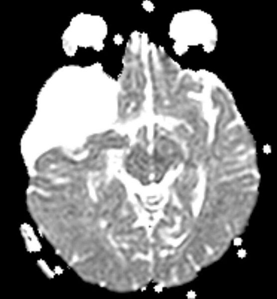 File:Arachnoid cyst- extremely large (Radiopaedia 68741-78451 Axial ADC 11).jpg